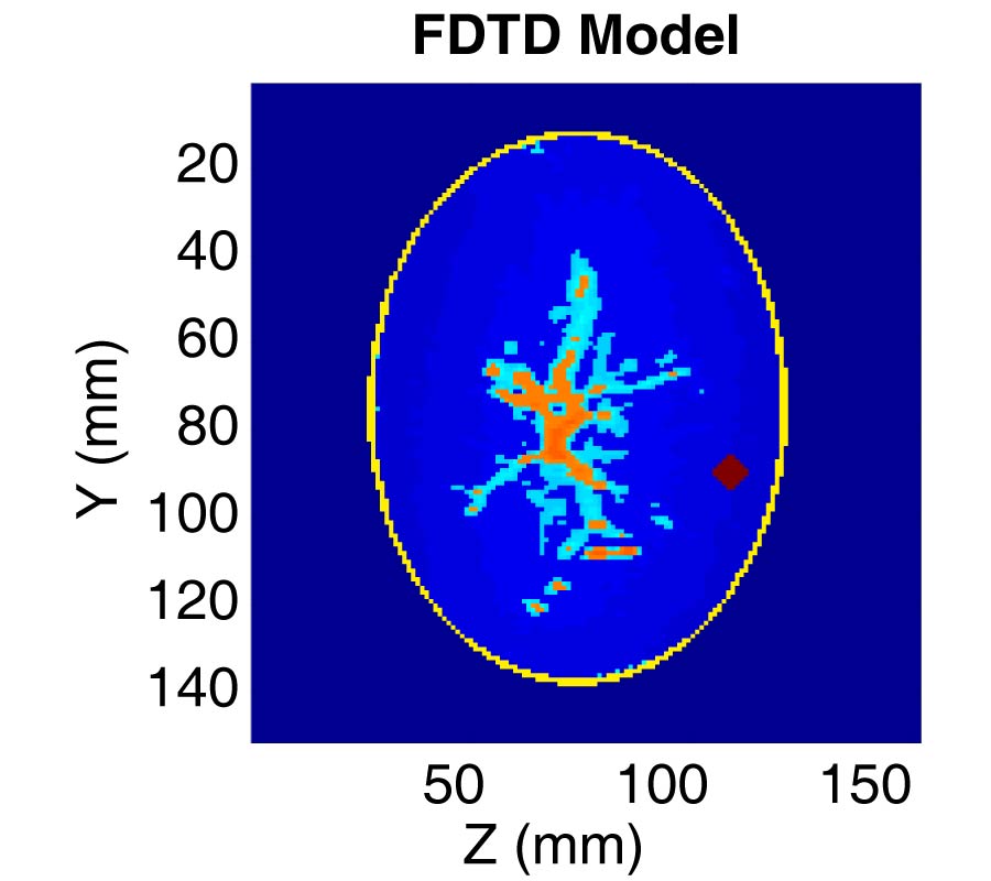 A PREPROCESSING FILTER FOR MULTISTATIC MICROWAVE BREAST IMAGING FOR ENHANCED TUMOUR DETECTION