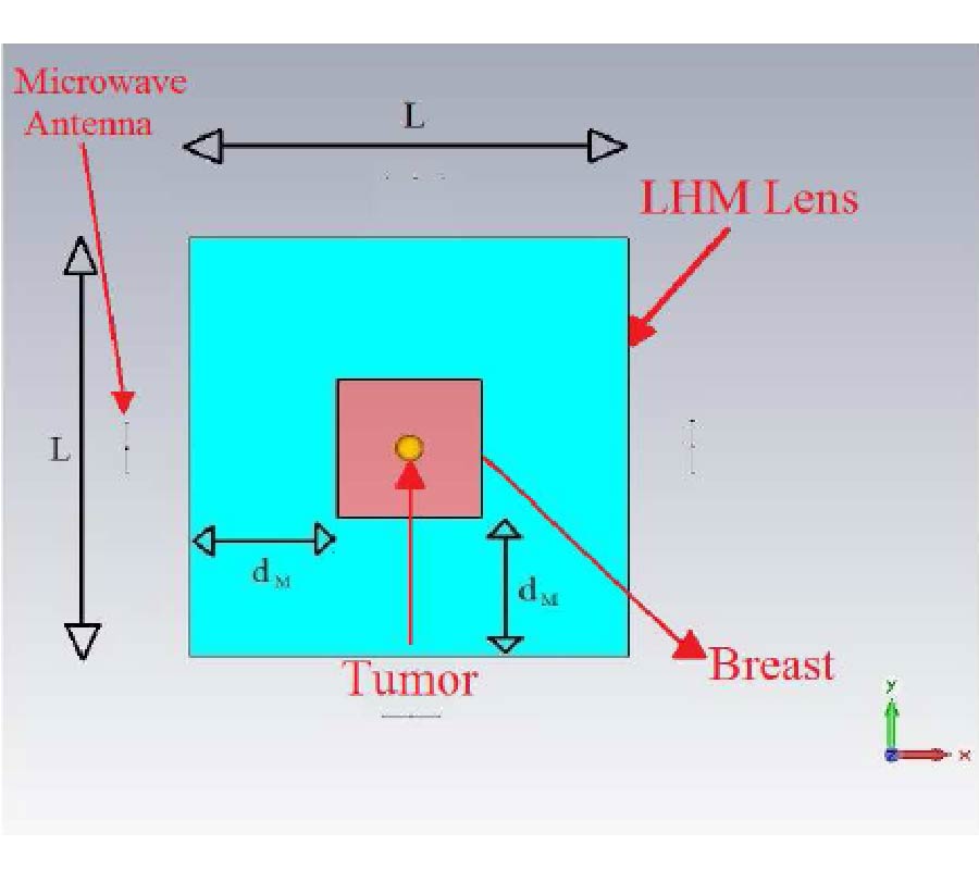 A COMPARISON BETWEEN DIFFERENT SCHEMES OF MICROWAVE CANCER HYPERTHERMIA TREATMENT BY MEANS OF LEFT-HANDED METAMATERIAL LENSES