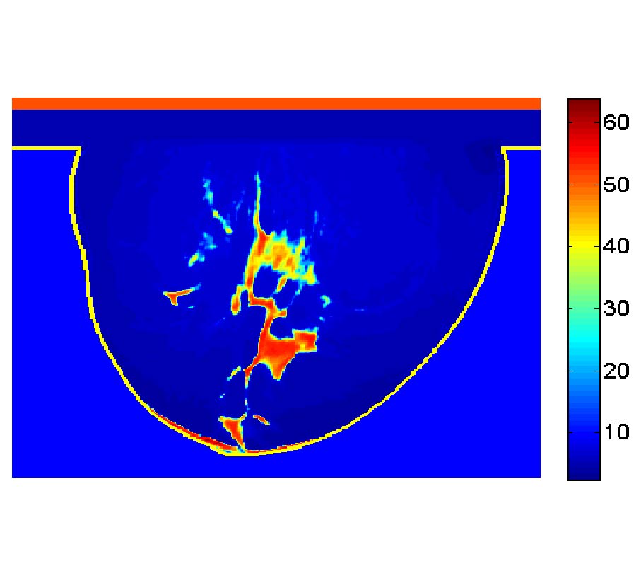 3D MICROWAVE TOMOGRAPHY WITH HUBER REGULARIZATION APPLIED TO REALISTIC NUMERICAL BREAST PHANTOMS