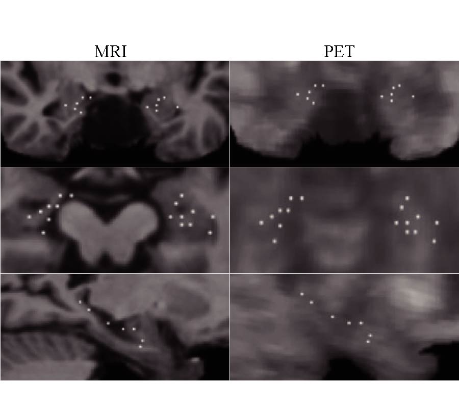 MULTIMODAL 2.5D CONVOLUTIONAL NEURAL NETWORK FOR DIAGNOSIS OF ALZHEIMER'S DISEASE WITH MAGNETIC RESONANCE IMAGING AND POSITRON EMISSION TOMOGRAPHY