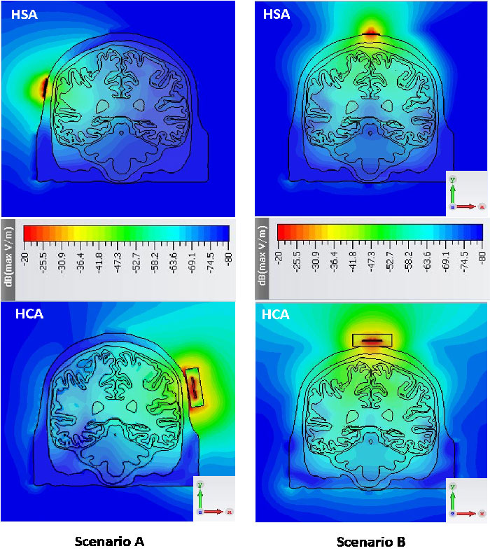 Slot Antenna in Cylindrical Coupling Brick for Microwave Brain Imaging